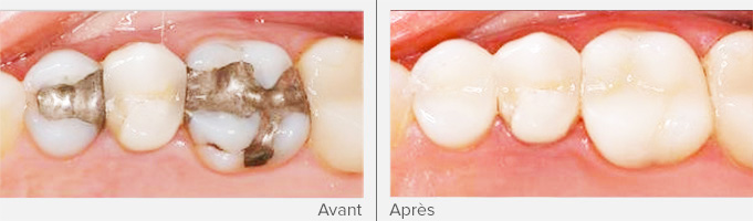 restauration-dentaire-int.-mini-4