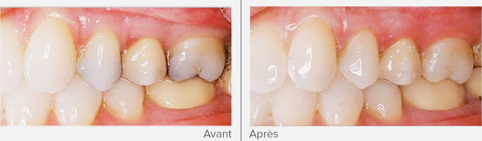 restauration-dentaire_3